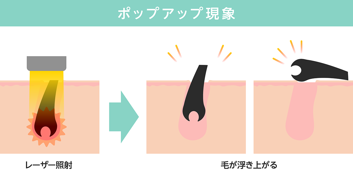 レーザー脱毛時にみられるポップアップ現象のイメージ